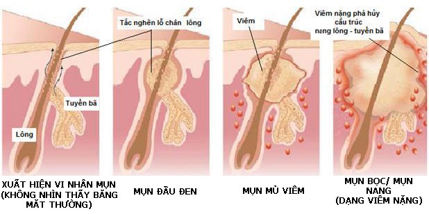 điều trị mụn đầu đen hiệu quả