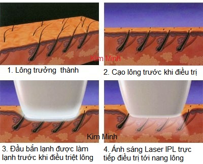 M&aacute;y triệt l&ocirc;ng lạnh OPT SHR 3000 Y Khoa Kim Minh nhập khẩu ch&iacute;nh h&atilde;ng