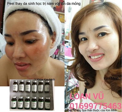 Bộ Peel thay da sinh học Botox Matrigen Hàn Quốc trị nám trắng mịn da - Y Khoa Kim Minh