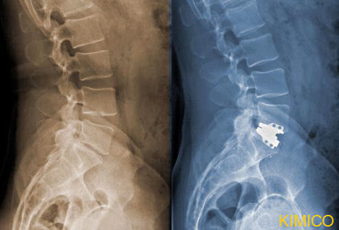 Giảm đau cột sống tho&aacute;t vị đĩa đệm