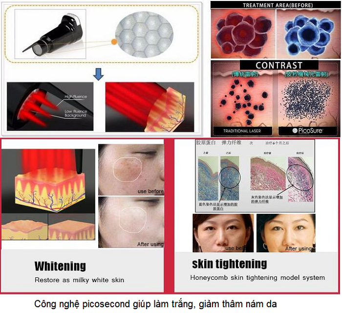 Máy laser picosecond giúp điều trị da tăng sắc tố rất hiệu quả - Y khoa Kim Minh