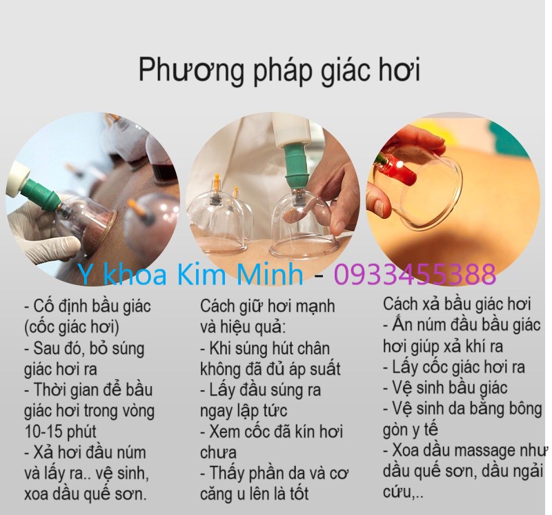 Phương pháp giác hơi không dùng lửa