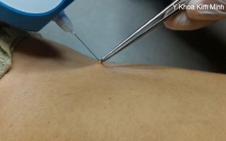 May dot not ruoi xoa tan nhang nam plasma laser pen y khoa kim minh tp hochiminh nhap khau phan phoi