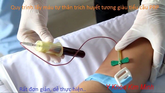 Phương pháp lấy máu li tâm trích huyết tương giàu tiểu cầu PRP - Y khoa Kim Minh Qui trinh trich xuat huyet tuong giau tieu cau PRP tai tao tre hoa da, dieu tri seo - Y khoa Kim Minh