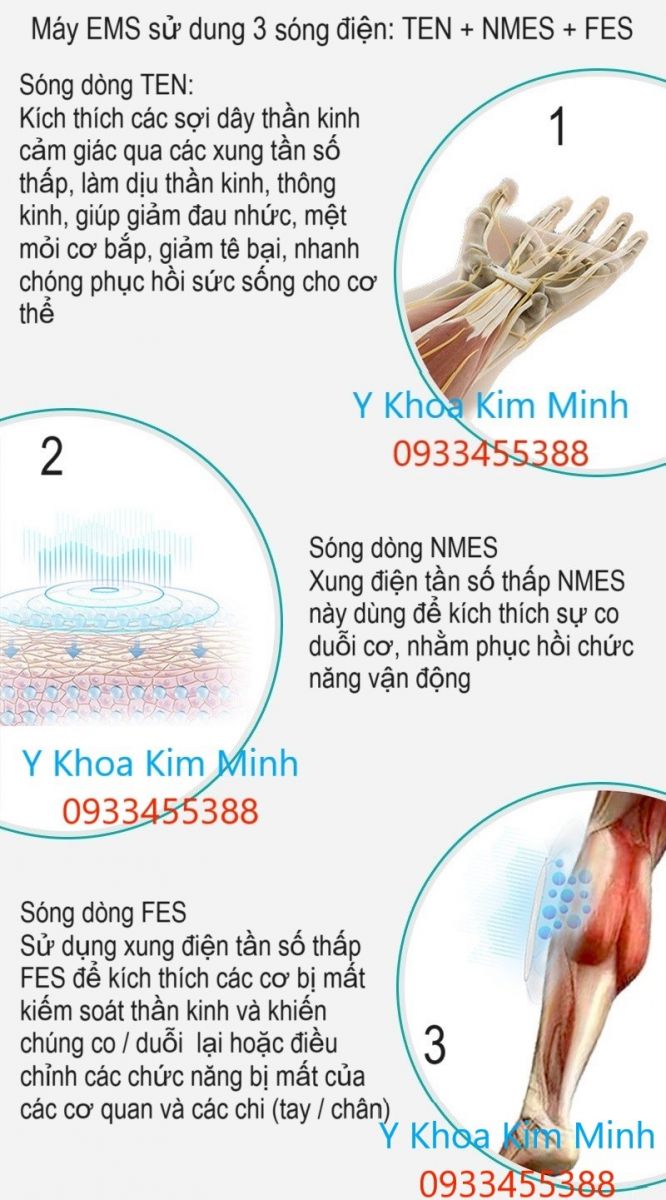 Sóng xung điện EMS, TEN, NMES, FES là gì, có thể giúp điều trị người tai biến đột quỵ