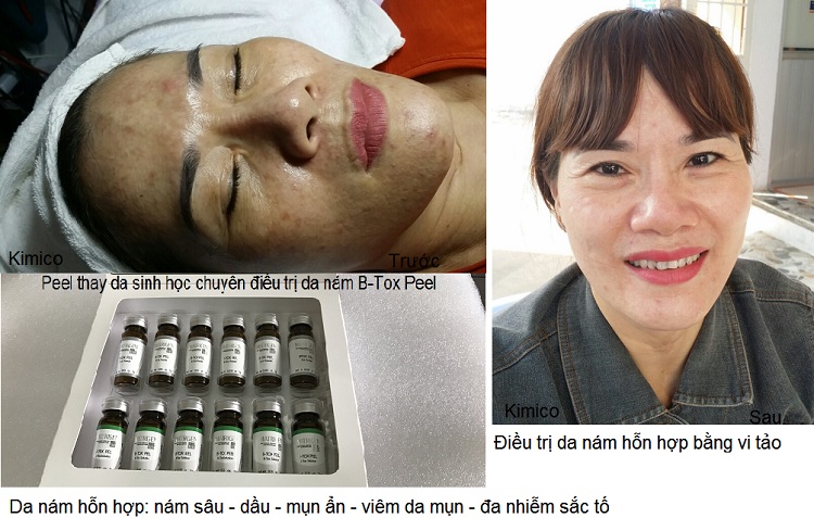 Peel Matrigen B-Tox thay da sinh hoc bang vi tao song Han quoc Y Khoa Kim Minh tri nam hon hop va nam sau