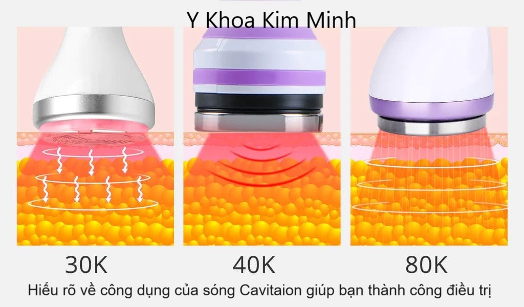 So sánh sóng siêu âm đánh tan mỡ body 30K, 40K, 80K của máy giảm béo mini