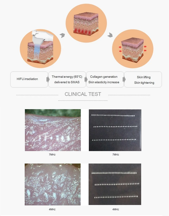 So sanh ket qua dieu tri nang co vline tre hoa da bang may HIFU 3D - Y khoa Kim Minh