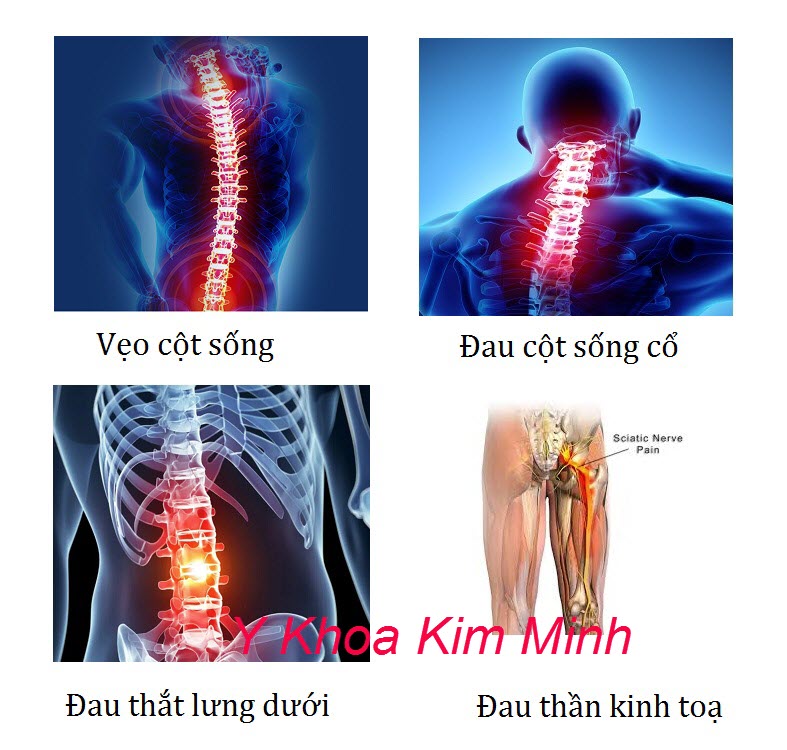 Súng nắn chỉnh cộ sống điều trị bệnh thoát vị đĩa đệm, bệnh thần kinh toa