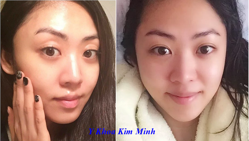 Tao lan da cang bong thien than Baby Face bang te bao goc - Y khoa Kim Minh