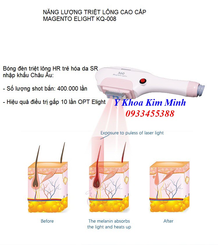 Tay cầm triệt lông máy HR SR Elight KQ-008 - Y Khoa Kim Minh Tay cầm triệt lông trẻ hóa da HR SR máy Elight KQ-008 - Y Khoa Kim Minh 0933455388