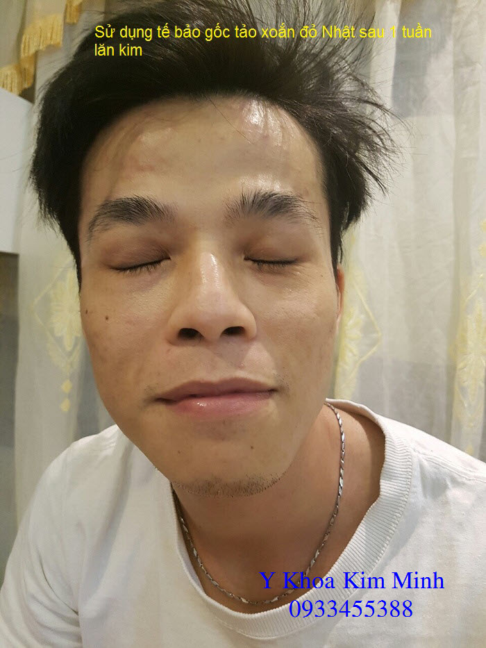 Su dung te bao goc do tao xoan Nhat lan kim tri mun Y Khoa Kim Minh