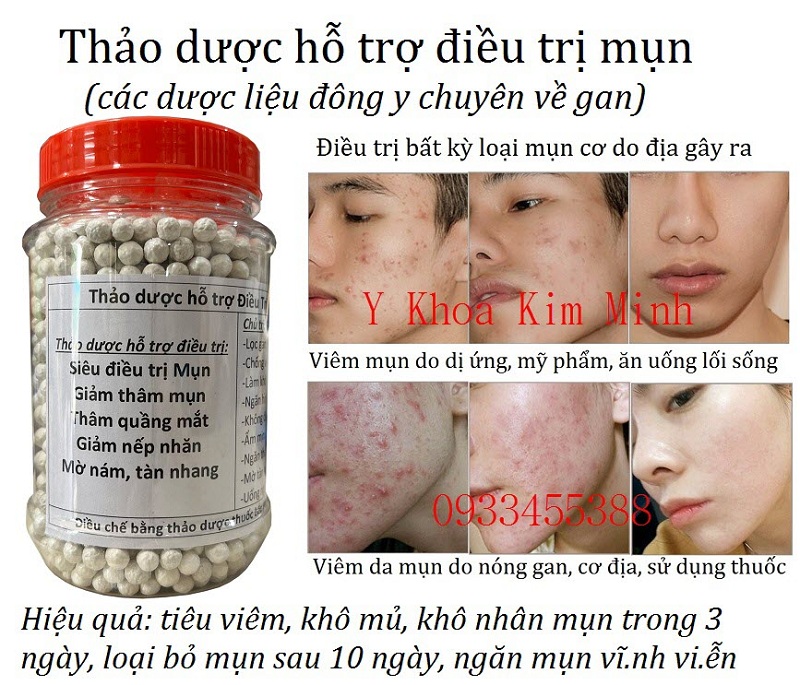 Viên thảo dược trắng điều trị mun hiểu quả và ngăn mụn hình thành trở lai