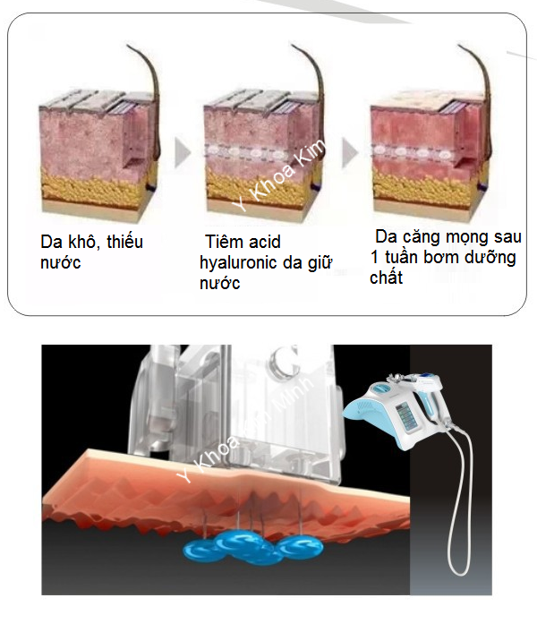Thiet bi bom duong chat truc tiep vao da Y Khoa Kim Minh
