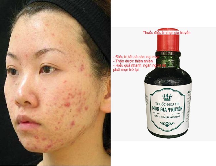 Thuoc dac tri mun gia truyen dong y mua o dau tot nhat Y Khoa Kim Minh