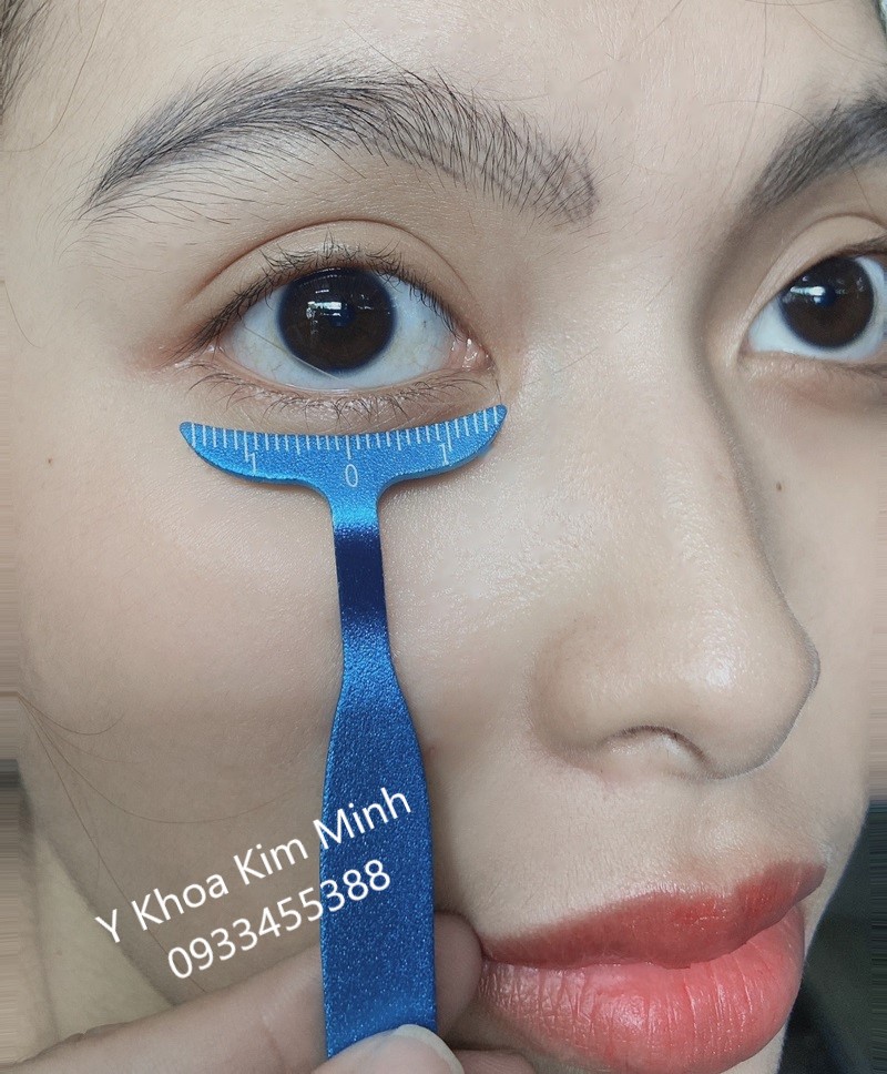 Thước đo mí mắt trước khi lấy bọng mắt, mở đuôi mắt, tạo đôi mắt phượng ngài