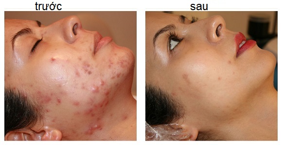 Thuoc dac dieu tri mun gia truyen dong y thien nhien Y Khoa Kim Minh