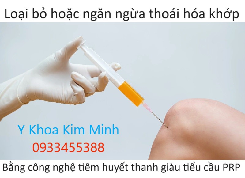 Điều trị thoái hóa khớp gối bằng kim cannula đầu cùn tiêm huyết thanh PRP tự thân giàu tiểu cầu