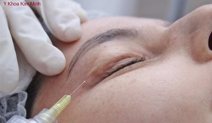 Dieu tri tham quang mat, nhan, bong mat bang lieu phap Carboxy CO2 Kim Minh 0933455388