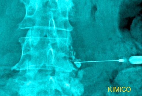 Ti&ecirc;m thuốc v&agrave;o v&ugrave;ng đau cột sống