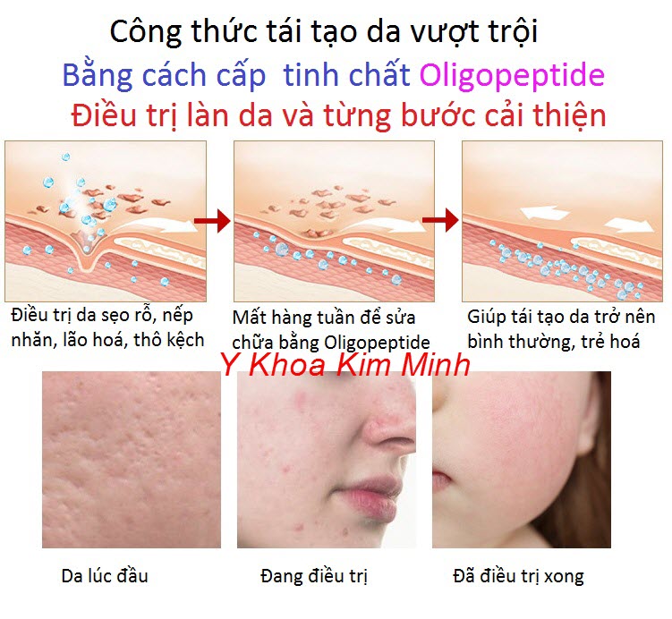 Tinh chất Oligopeptide điều trị sẹo rỗ sẹo mụn kết hợp với EGF rất hiệu quả