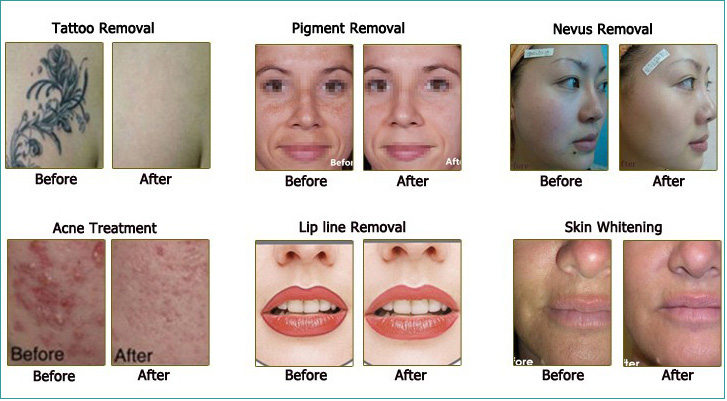 Tính năng điều trị và công dụng của máy laser xóa xăm trị nám trẻ hóa da SKM-219 - Y Khoa Kim Minh 0933455388