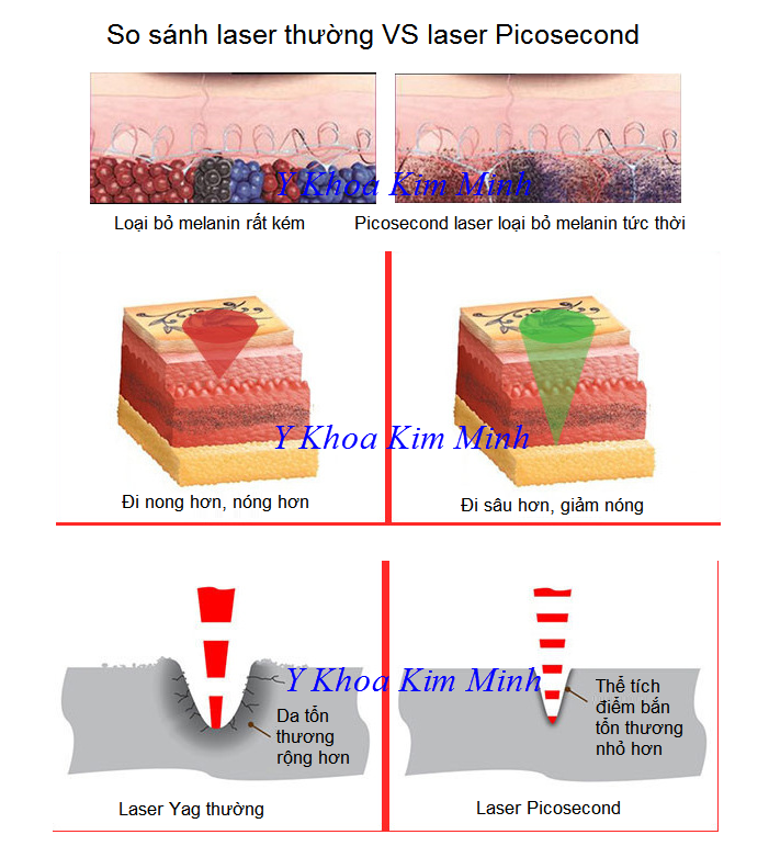 So sánh tính năng của laser yag và laser điều trị sắc tố da picosecond 755nm - Y Khoa Kim Minh