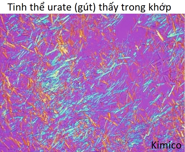Tinh thể urate crystals, axit uric gây ra bệnh gout làm đau các khớp chân, ngón tay - Y khoa Kim Minh