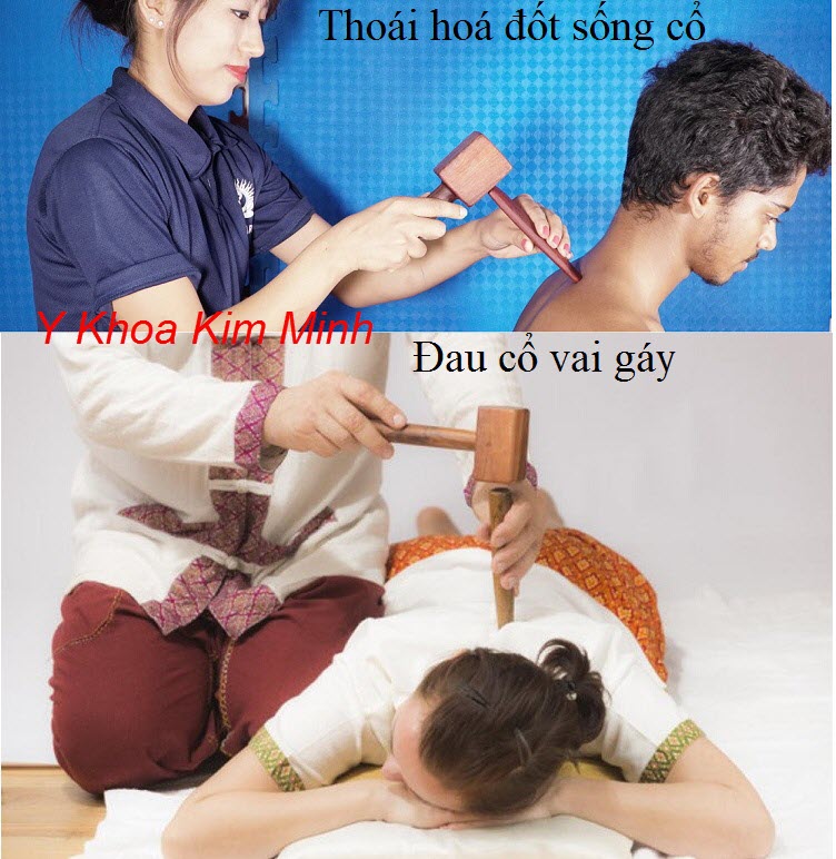 Chữa thoái hoá đốt sống cổ, đau cổ vai gáy bằng liệu pháp Tok Sen - Y khoa Kim Minh