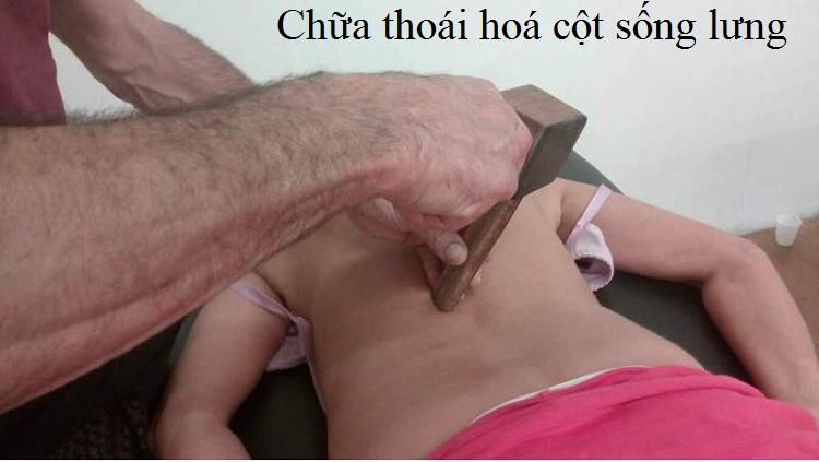 Tok Sen trị thoái hoá cột sống lưng, thoát vị đĩa đệm - Y khoa Kim Minh