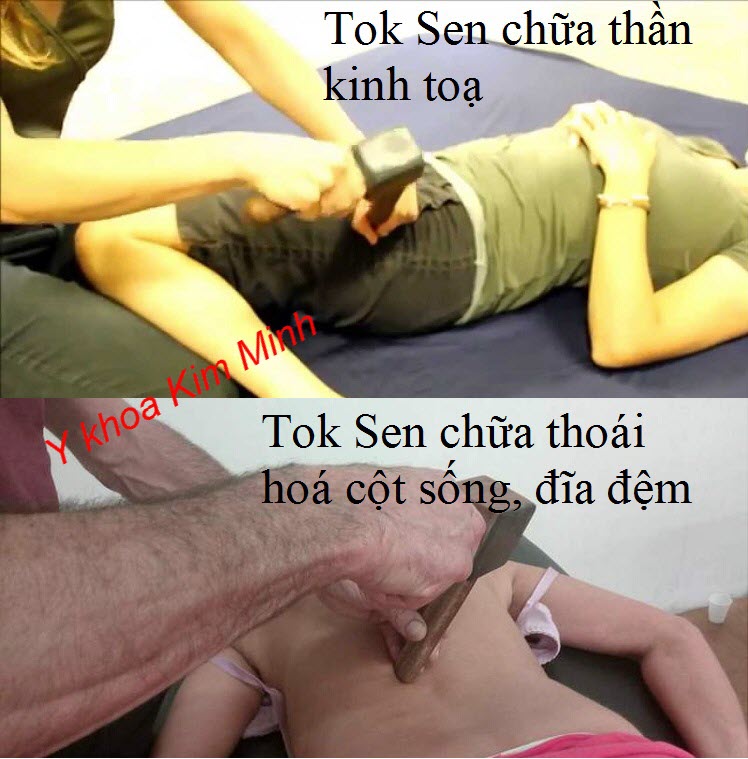 Liệu pháp Tok Sen giúp chữa thoát vị đĩa đệm, đau cột sống, đau thần kinh toạ - Y khoa Kim Minh