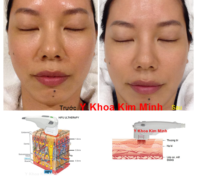 Công nghệ trẻ hóa da tức thì SMAS Ulthera HIFU V-258 - Y khoa Kim Minh Máy trẻ hóa da nâng cơ Ulthera Hifu SMAS V-258 - Y khoa Kim Minh