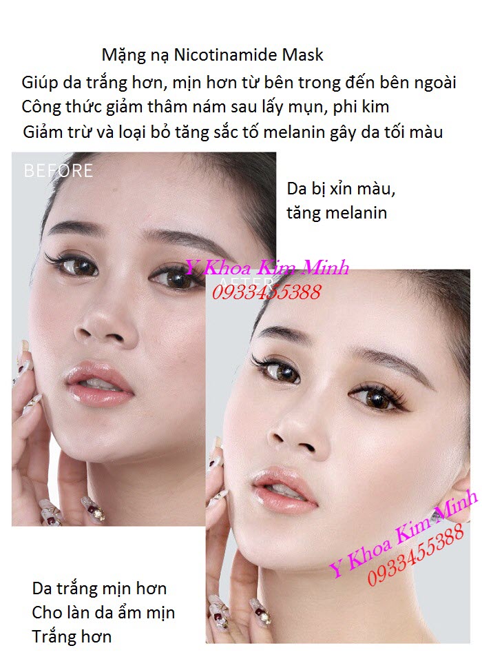 Kết quả trước và sau đắp mặt nạ Nicotinamide giúp da trắng mịn hơn, ẩm hơn - Y Khoa Kim Minh