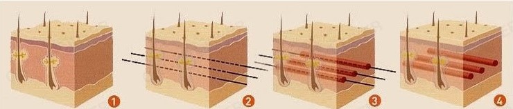 Chỉ Ultra V Lift 4D Gold 30mm 50mm 80mm chỉ xoắn 4D h&agrave;n quốc Y Khoa Kim Minh