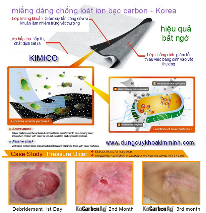 Miếng dáng điều trị vết loét người bệnh BCT ion carbon bạc 10x10cm, 20x20cm - Y Khoa Kim Minh Su dung mieng dan dieu tri lo let lung nguoi benh nam liet, BCT ion carbon bac - Y Khoa Kim Minh