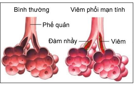tac nghen phoi man tinh la gi COPD l&agrave; g&igrave;