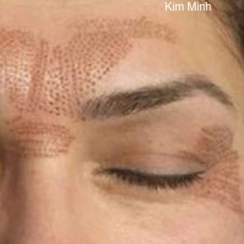 Xóa nhăn nhan mi dot not ruoi bang but dot dien plasma pen Y Khoa Kim Minh tp Hochiminh