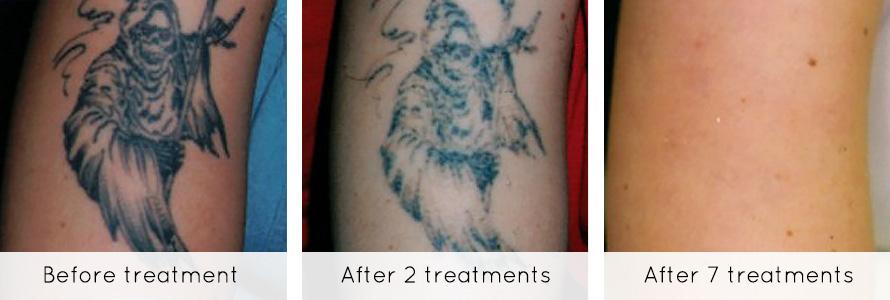 X&oacute;a xăm laser c&ocirc;ng nghệ mới