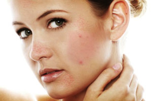 phương pháp điều trị mụn hiệu quả