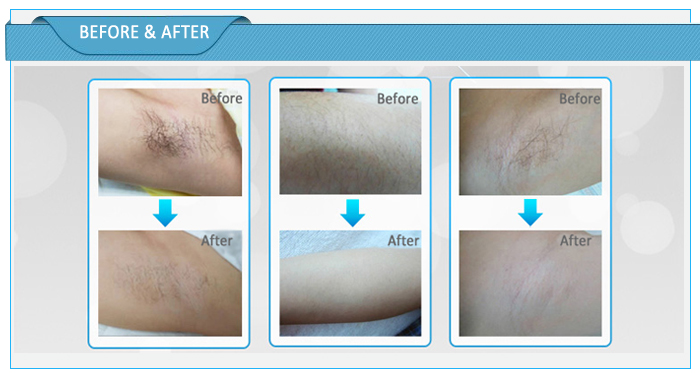 máy triệt lông ở đâu tốt mini KGP-580 Y Khoa Kim Minh Thành Thái Q10