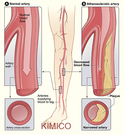 Bệnh thuyên tắc động mạch ngoại biên