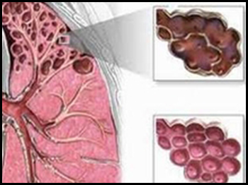 bệnh suy tắc nghẽn phổi mạn t&iacute;nh COPD