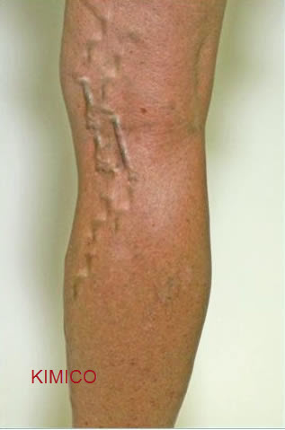 bệnh suy gi&atilde;n tĩnh mạch ch&acirc;n