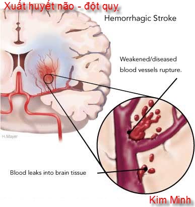 tai biến mạch máu não, cơn đột quỵ