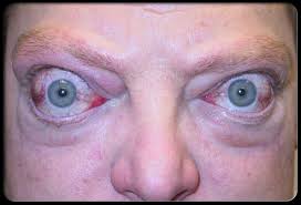 Chữa trị bướu cường giáp