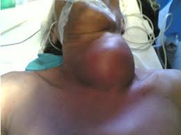 Chữa trị bướu giáp