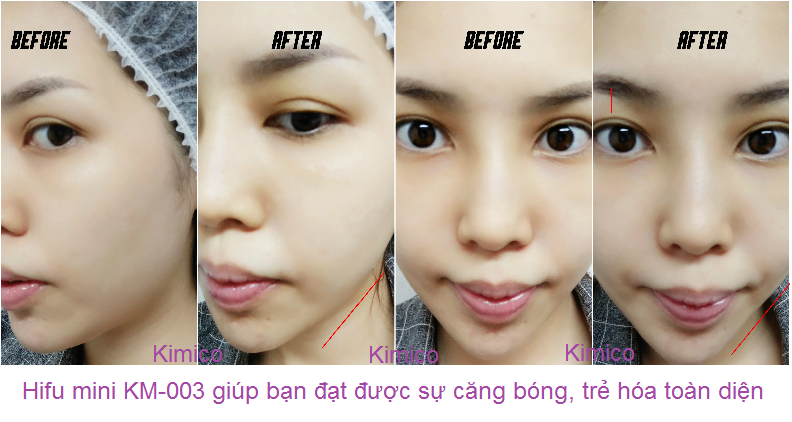 Cang da chong nhan tre hoa da bang may hifu mini KM-003 ban tai Y khoa Kim Minh 0933455388