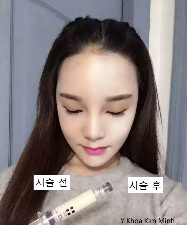 Cay phan nuoi da trang min Meso White BB Covered Han Quoc