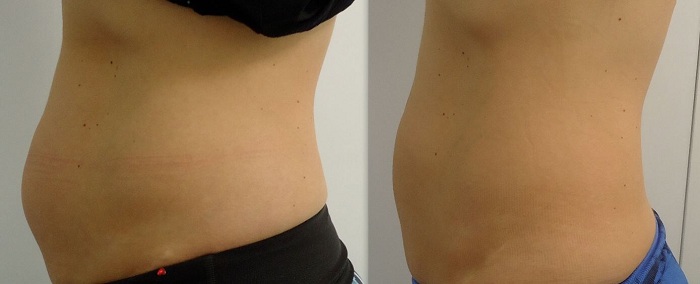 Chich phan giai mo giam beo nhanh bang lipolytic solution mesoestetic Y Khoa Kim Minh