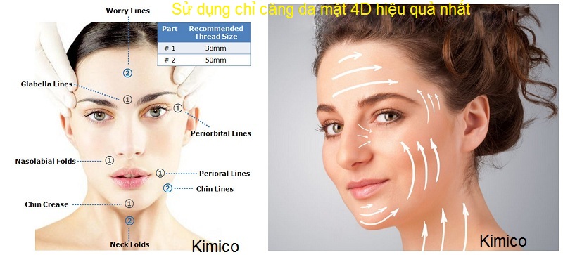 Sử dụng chỉ căng da mặt đ&uacute;ng cho khu&ocirc;n mặt 4D Ultra V Lift H&agrave;n Quốc Y Khoa Kim Minh